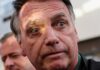 Jair Bolsonaro sofre com soluços intensos e dificuldade para respirar, afirma filho