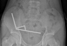 Menino de 13 anos perde parte do intestino após ingerir ímãs magnéticos