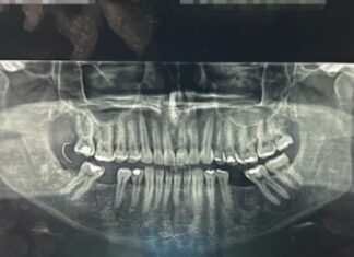 Agulha fica alojada na gengiva e é encontrada 10 dias após procedimento dentário