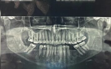 Agulha fica alojada na gengiva e é encontrada 10 dias após procedimento dentário